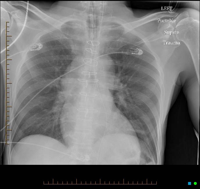 57-year-old male diagnosed with Central Nervous System Blastomycosis