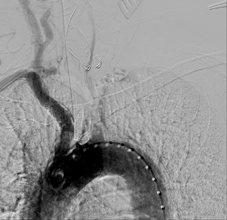Arch aortogram reveals a critical 90% stenosis of the origin of the left common carotid artery with a difficult to appreciate 70% stenosis of the left internal carotid artery due to poor contrast filling. Incidental note is made of a critical stenosis of the left subclavian artery.