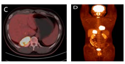  fusion shows a pleural hypermetabolic mass invading the right 11th  posterior rib.