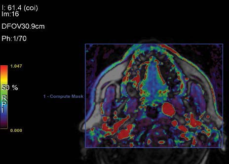 MRI of 66-year-old man