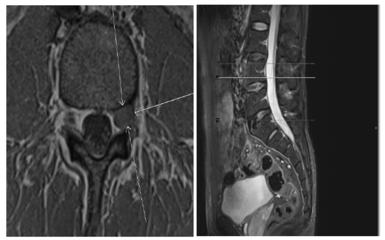 (D) Axial T1-weighted MRI with fat suppression of the lower third level of the L4 vertebral body. It can be seen that the left nerve running area has massive low-signal soft tissue (indicated by arrows), and the peripheral fat space disappears. (E) Sagittal T2-weighted MRI with fat suppression.