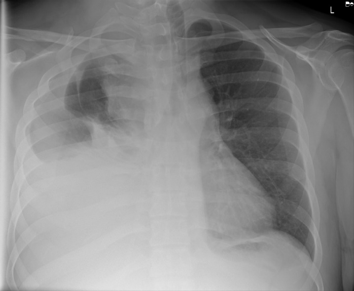 Single front view chest radiograph demonstrating large pleural effusion (star) with fluid tracking along the lateral chest wall (arrow heads) and subtotal atelectasis of the lung. Right hemidiaphragm is obscured in comparison to the left side.