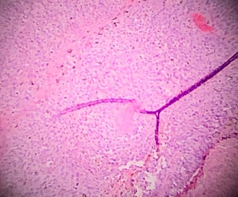 Histological hematoxylin and eosin stain at 10x magnification morphologically consistent (arrow) with primary malignant melanoma of the anus.