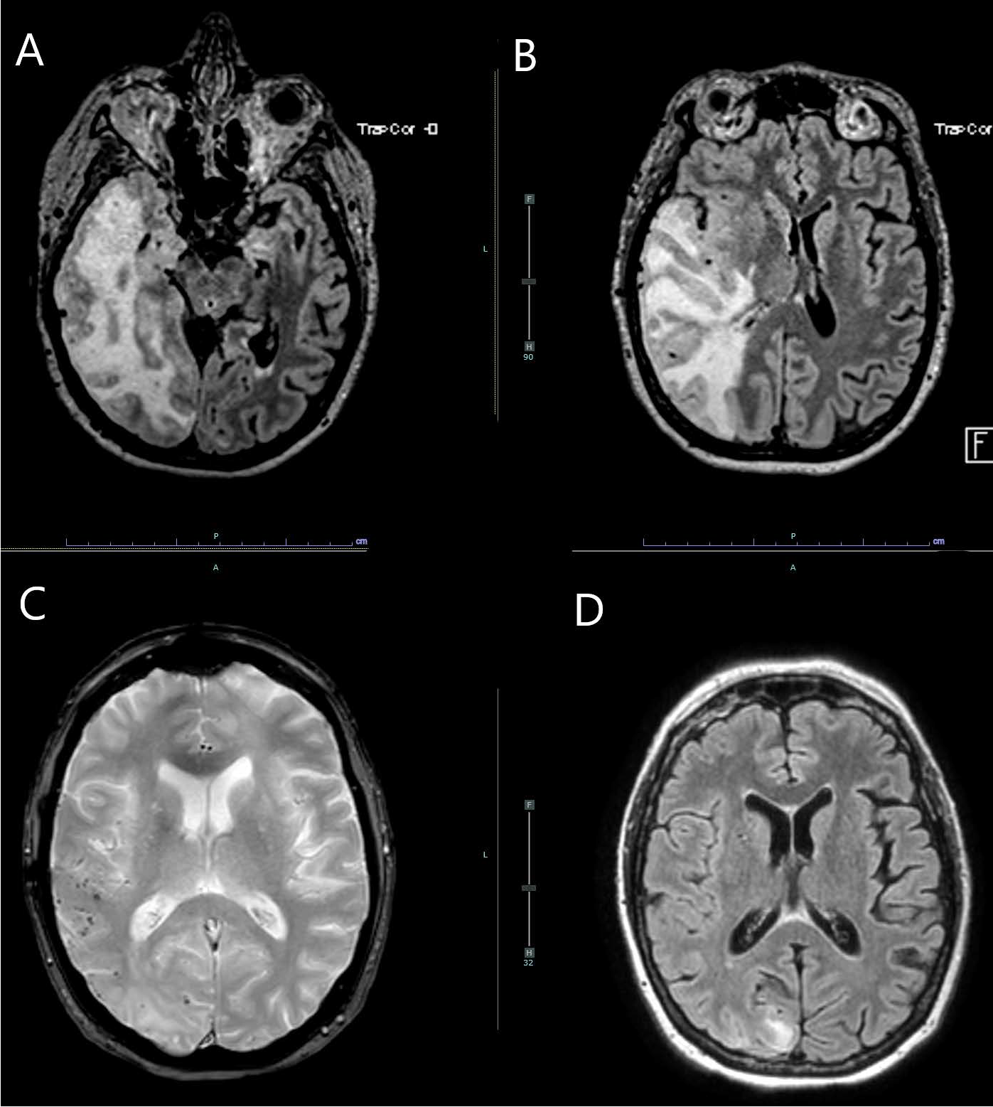 Axial post-contrast T2 FLAIR images (A and B) showing extensive vasogenic edema with cortical involvement affecting the right temporal, parietal and occipital lobes, causing 8 mm of leftward midline shift. Axial GRE (C) shows scattered cortical/subcortical microhemorrhages. Axial post-contrast T2 FLAIR (D) shows marked improvement in edema with mild residual edema in the right occipital lobe following treatment