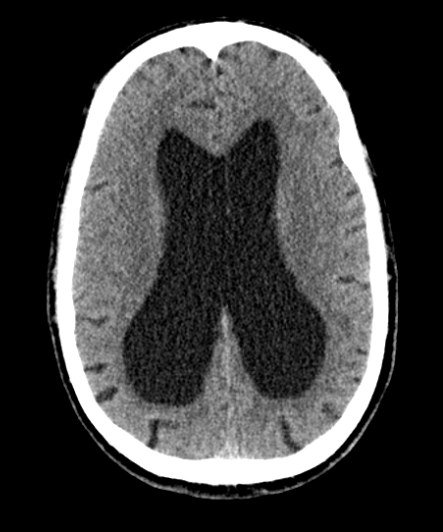 Axial CT view: Dilatation of lateral ventricle (Evans index: 0,39)