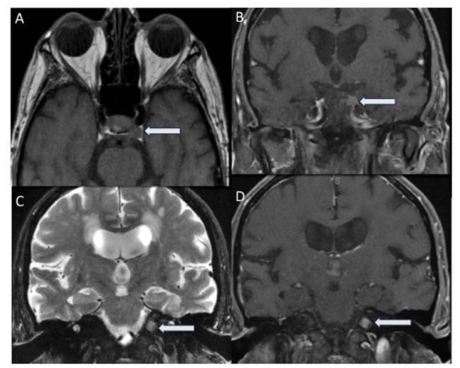 MRI orbits and without contrast, coronal T1-weighted with contrast