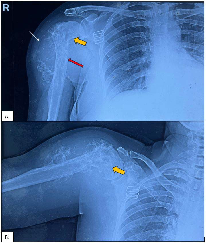 38-year-old female with desmoplastic fibroma in the right proximal humerus.