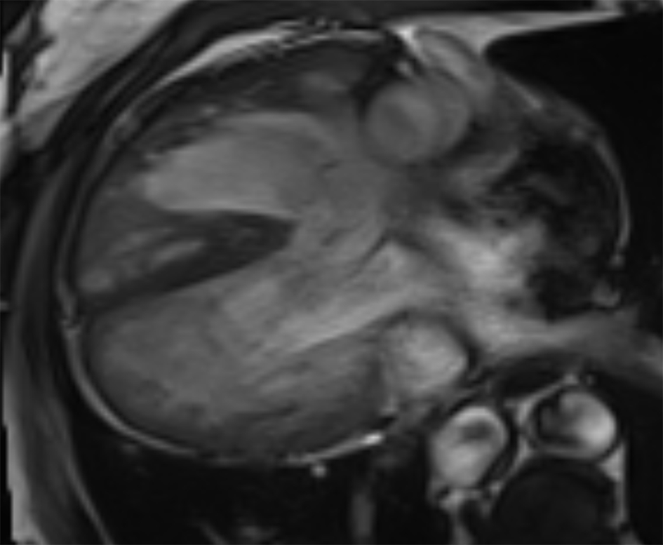 Balanced Steady State Free Precession (SSFP) cine image in the horizontal long-axis of the left ventricle shows dextrocardia and dextroapex. Right ventricular hypertrohpy is also seen.