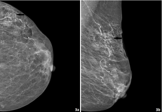 The left CC (a) and MLO (b) views from the post clip mammogram show the ribbon clip (arrows) at the biopsy site.