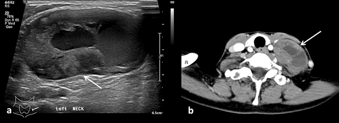 Ultrasound thyroid of a 63-year-old female (a) shows a mixed solid-cystic lesion (arrow) situated lateral to the left thyroid lobe. The characteristic ‘target sign’ of central hyperechoic and peripheral hypoechoic areas, is not well demonstrated here due to the mixed solid-cystic nature of the lesion. Axial CT scan (b) shows the mass (arrow) situated between the left common carotid artery and internal jugular vein. It enhances heterogeneously with low attenuating areas of necrosis. Histological analysis of the excised tumor specimens reveals a schwannoma.