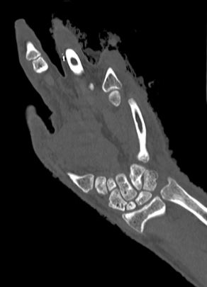 Coronal section scanner nonfractured wrist joint. This scaphoid is divided. The margins of both portions in the wrist are round and smooth