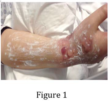 On first day of extravasation.
