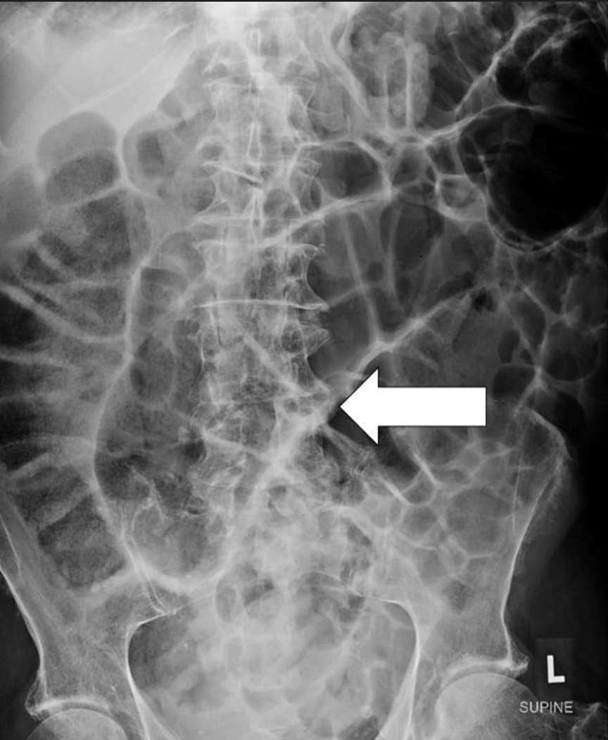 Supine abdominal radiograph demonstrated dilated large bowel loops (arrow).