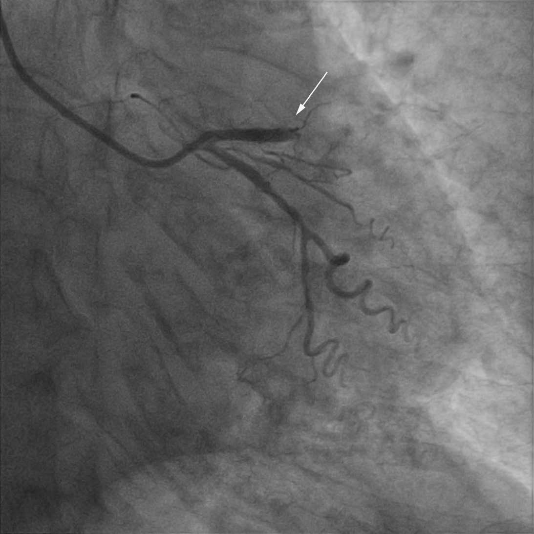 Preoperative imaging: complete occlusion of the proximal segment of the anterior descending branch