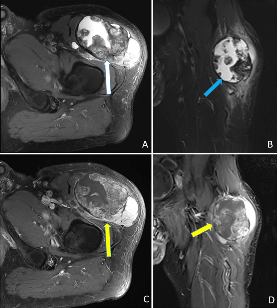 EOO in the left thigh. A (axial), B (coronal): Proton density sequence images without contrast demonstrate a 9.5 x 6.2 x 8.0 cm mass with mixed solid (yellow arrow) and liquid (blue arrow) components. C (axial), D (coronal): Contrast enhanced T1-weighted MRI images show inhomogeneous contrast uptake (yellow arrows).