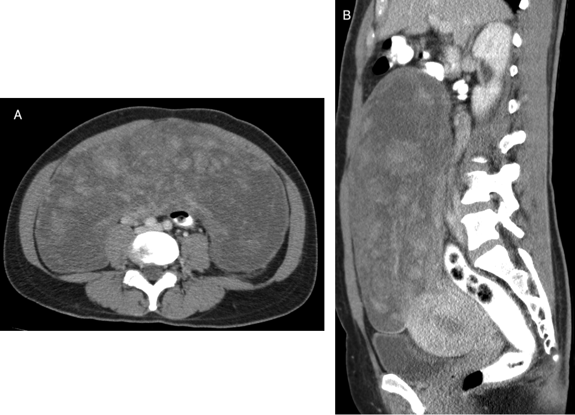 Pre-operative Contrast enhanced CT abdomen and pelvis. Axial (A) and sagittal (B) images show a very large heterogeneous abdominopelvic mass arising from the uterus, containing several small nodular enhancing foci.