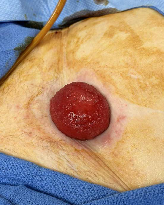 Urinary bladder herniation through patient’s suprapubic tract