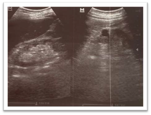 Ultrasonography of the kidneys