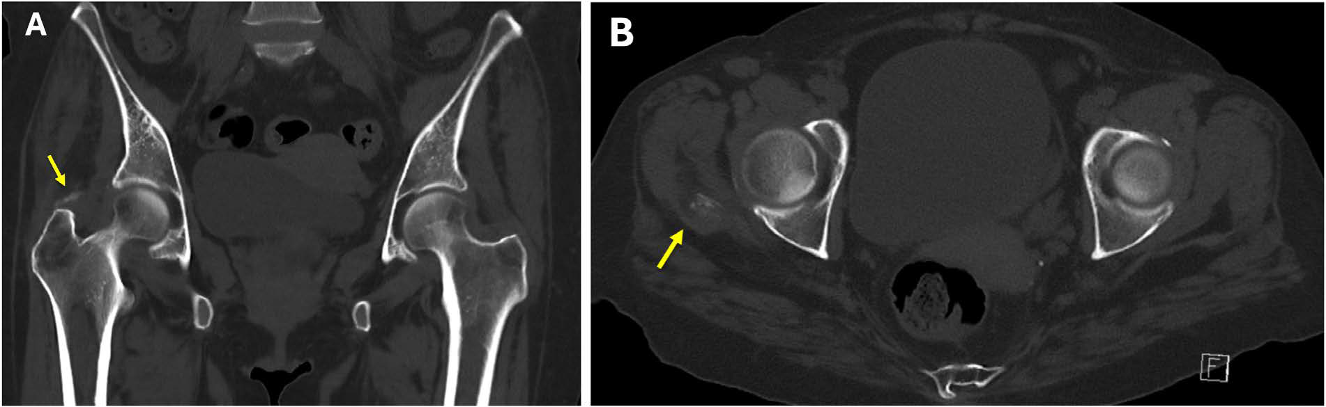 A 52-year old female with hydroxyapatite deposition disorder. FINDINGS: A small area of poorly defined calcification at site of right gluteus medius insertion into right greater trochanter (arrows). TECHNIQUE: A Non-contrast computed tomography coronal (a) and axial (b) images of the pelvis