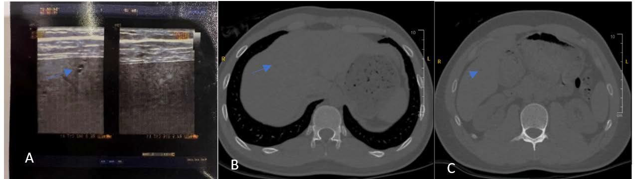 A: Abdominal ultrasound revealed a few liver cysts, all measuring less than 5 mm in diameter (arrows).