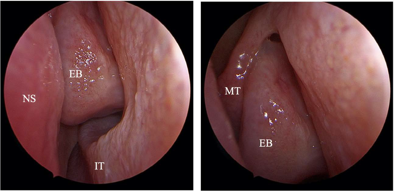 Endoscopic images of left nasal cavity examination showing enlarged pneumatized ethmoid bulla (EB) and healthy-looking nasal mucosa using 0-degree nasal endoscopy. The nasal septum (NS), inferior turbinate (IT) and middle turbinate (MT) are well-demarcated.