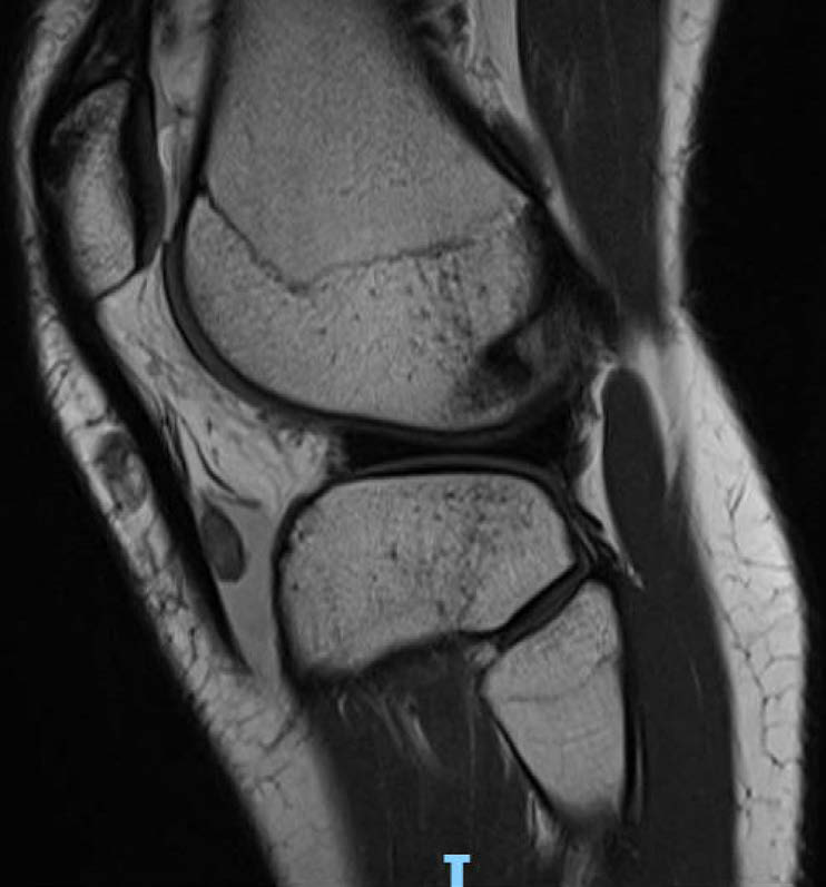PD sequence in MRI knee of a 17 year old female shows an oval hypointense nodule in the deep infrapatellar bursa with mild bursal fluid.
