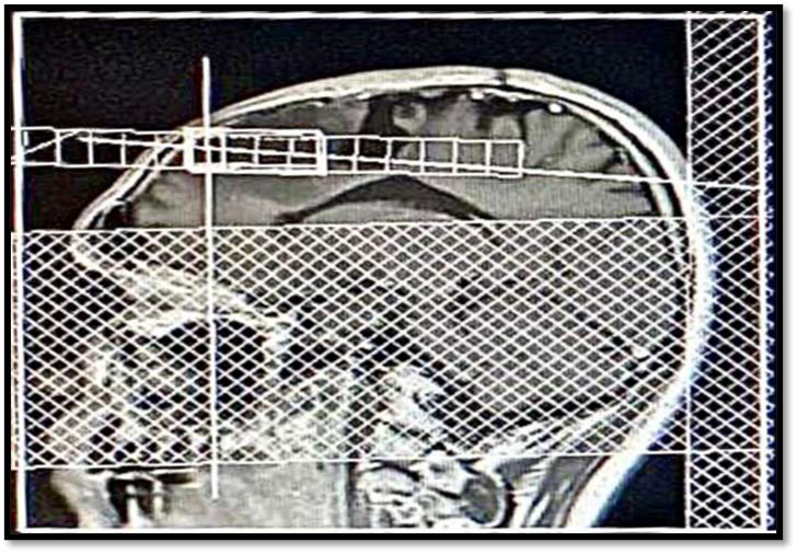 MRS single voxel sagittal plan