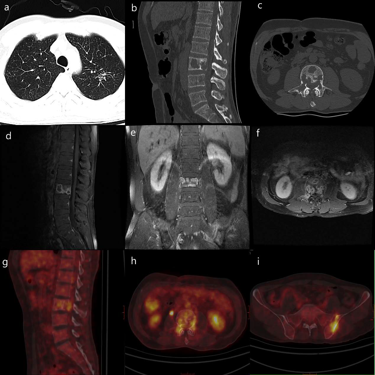 59-year-old male with single vertebra tuberculosis
