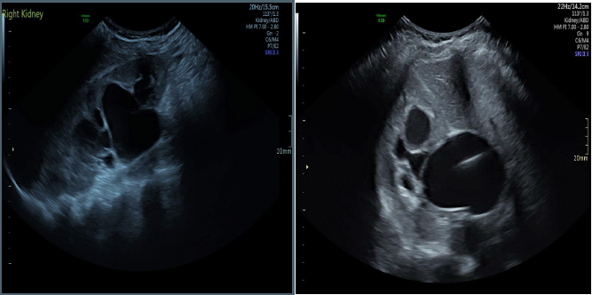 Multiple hypoechoic rounded and tubular anechoic structures at the renal hilum.