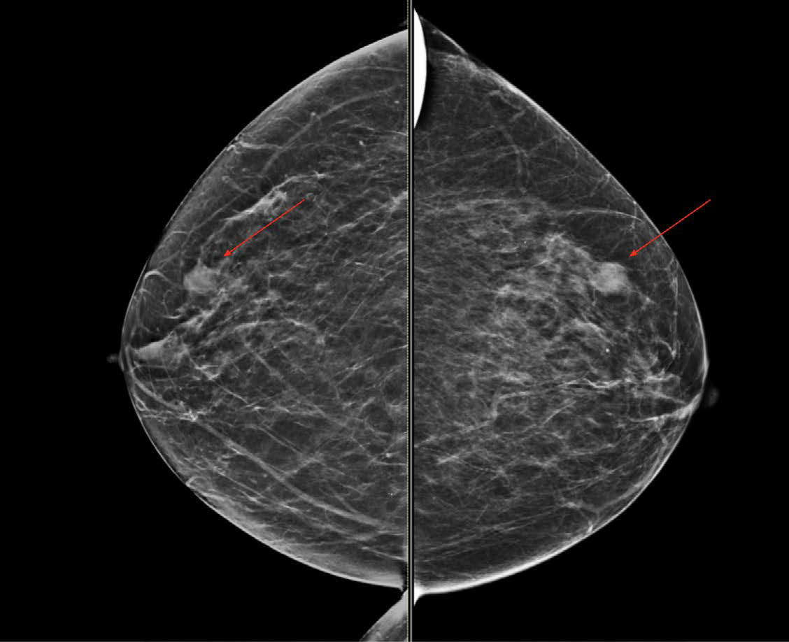 Bilateral craniocaudal mammographic views demonstrate bilateral breast nodules as indicated by red arrows.