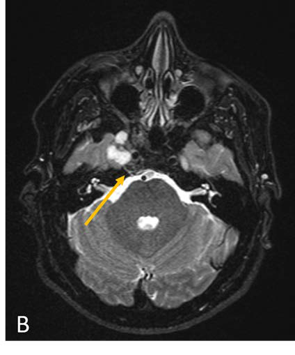 Coronal MPRAGE post contrast T1