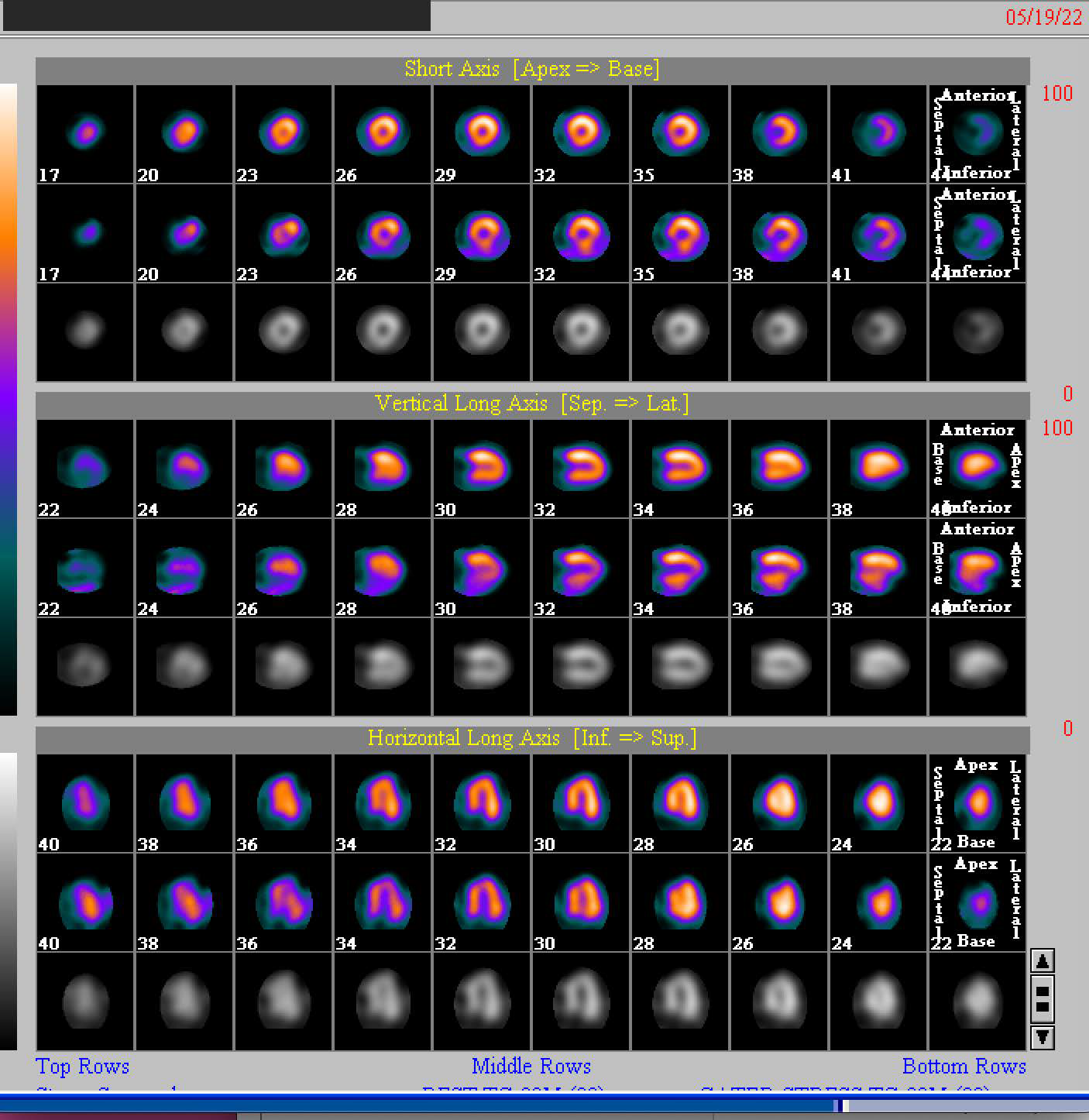 60 years old female with chest pain that led to the diagnosis of thymoma. SPECT myocardial perfusion scans were normal