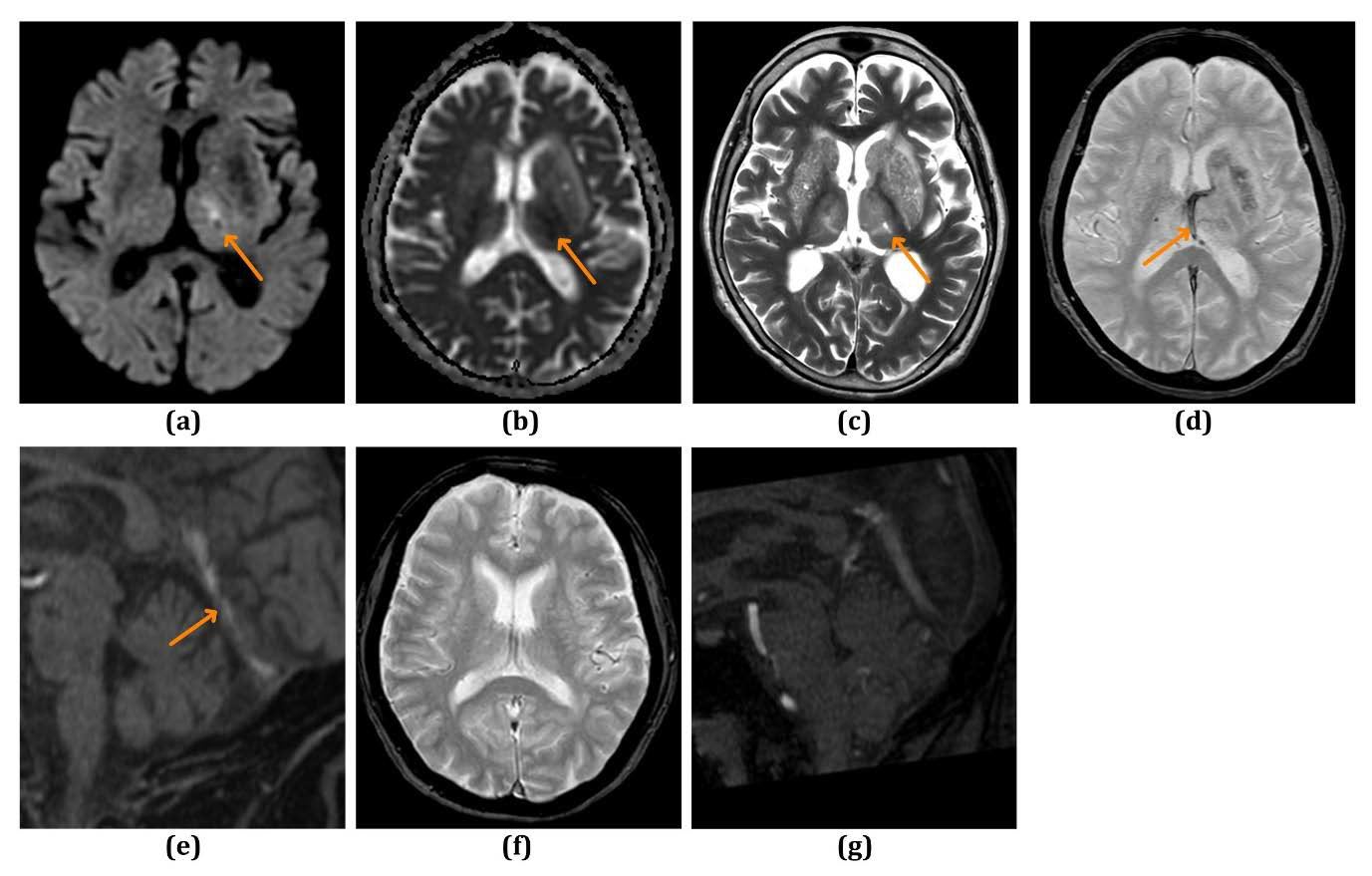 MRI images of a 91-year-old female with left internal cerebral venous thrombosis.