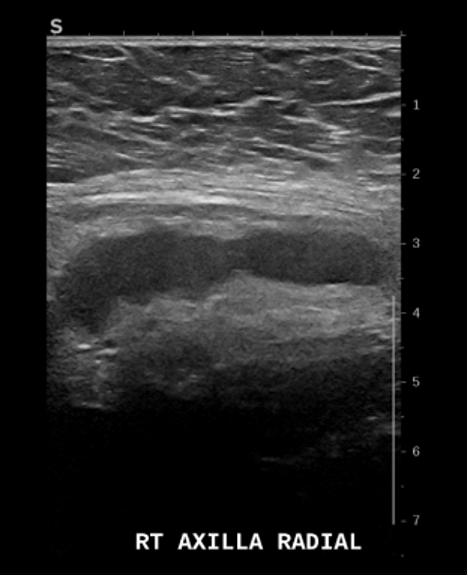 Diagnostic ultrasound following incidental finding of right axillary lymphadenopathy on MRI of the abdomen. Findings: Multiple level II lymph nodes (BI-RADS category 4), correlating with previous MRI findings. Biopsy of these lymph nodes was recommended for pathology and cytology. Technique: Diagnostic targeted greyscale right axillary ultrasound performed in a dedicated Breast Center.