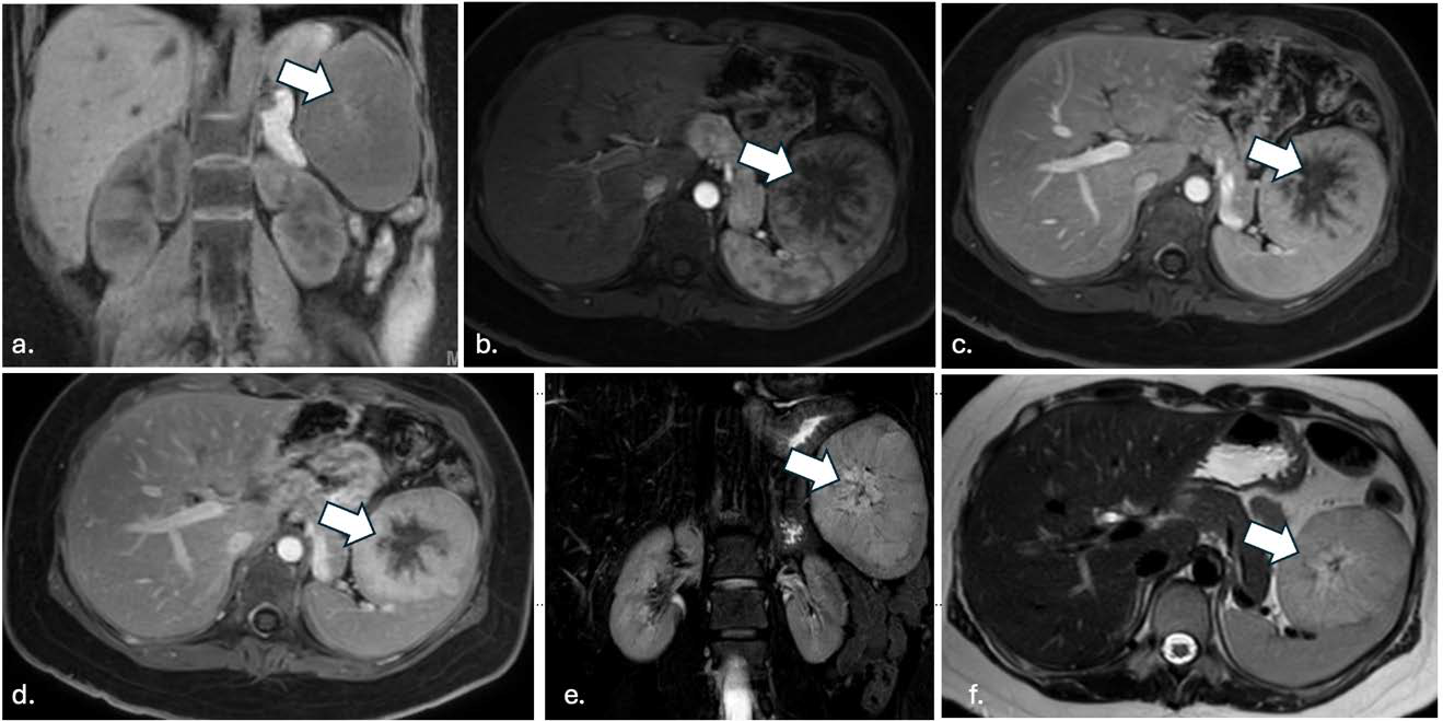 18-year-old female with splenic lymphangioma. MRI Abdomen showed a well-defined focal mass (arrows) at the anterior spleen measuring 8.1 x 6.4 x 9.0 cm, with progressive peripheral enhancement through delayed imaging with a central non-enhancing stellate component, likely reflecting fibrotic changes. (A) MRI abdomen T1 late arterial phase postcontrast, coronal view; (B) T1 late arterial phase postcontrast, axial view (C) T1 venous phase postcontrast, axial view; (D) T1 5 minutes postcontrast, axial view; (E) T2, coronal view; (F) T2, axial view.