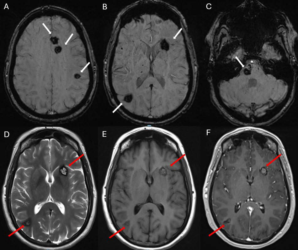51 years old female with known cavernous malformations, prior MRI brain with contrast. A, B and C: Axial Susceptibility weighted images (SWI) showing multiple foci of blooming in the supratentorial brain parenchyma and brain stem corresponding to patient’s known cavernous malformations (white arrows). D: Axial T2 sequence showing typical “popcorn appearance with central T2 hyperintensity and peripheral T2 dark rim (red arrows). E: Axial T1 and F: Axial T1 post contrast MPRAGE images showing mild intrinsic T1 hyperintensity within the lesions representing subacute blood products with questionable subtle enhancement (red arrows).