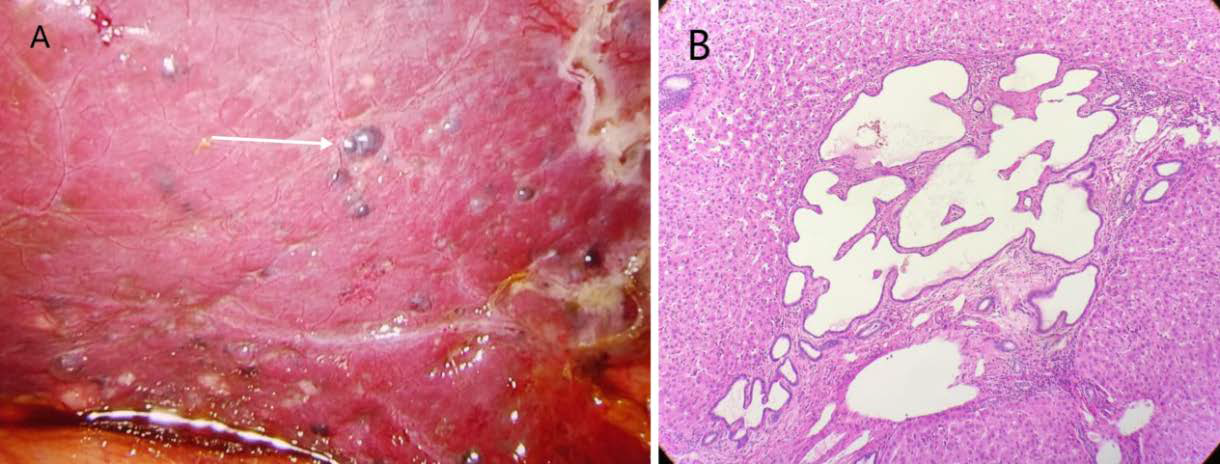 59-year-old male with Multiple biliary hamartomas (MBH) in liver. (2022) 2A: Multiple dark purple nodules of varying sizes (ranging from millimeters to centimeters) are scattered on the liver surface, with smooth surfaces. Their dark purple color suggests possible blood stasis or tissue changes, distinguishing them from normal liver tissue. 2B: Pathological images show multiple irregularly dilated biliary duct-like structures lined by uniform cuboidal epithelial cells, embedded in a dense, grayish-white, tough fibrous stroma. These findings are consistent with biliary hamartoma (magnification, ×100).