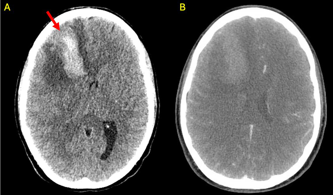 30-year-old female with bacterial endocarditis- CT.