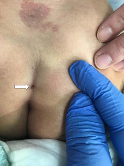 A 4-year-old boy with recurrent urinary tract infections who subsequently experienced lower-limb weakness due to pyogenic myelitis secondary to congenital dermal sinus.