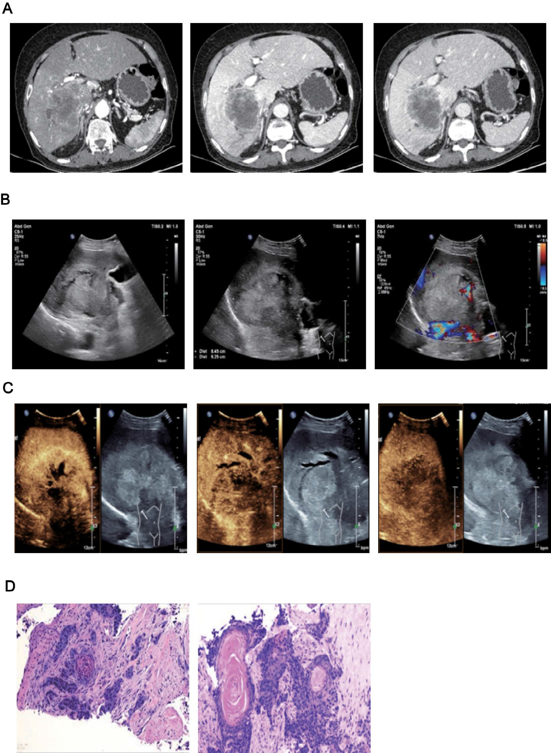Contrast-enhanced abdominal CT (A): Two-dimensional ultrasound (B): Contrast-enhanced ultrasound (C): The immunohistochemical results (D)