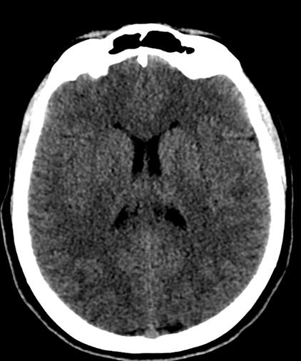 The non-contrast CT scan did not reveal any evident focal lesions in the brain tissue.