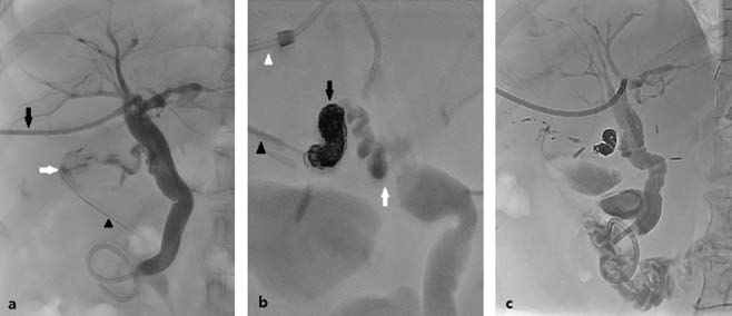 (a) Catheter-based cholangiography (black arrow) confirms bile leakage from the cystic duct stump (white arrow). A small volume of contrast medium is observed draining through a Jackson-Pratt catheter (arrowhead). (b) Following unsuccessful cannulation via percutaneous biliary drainage catheter (white arrowhead) due to acute angulation of the cystic duct, direct percutaneous access to the leakage site was achieved (black arrowhead) under fluoroscopic guidance. The cystic duct stump was embolized with microcoils (black arrow), autologous blood, and n-butyl-2-cyanoacrylate with Lipiodol (white arrow). (c) Immediate post-embolization cholangiography shows successful occlusion of the cystic duct stump.