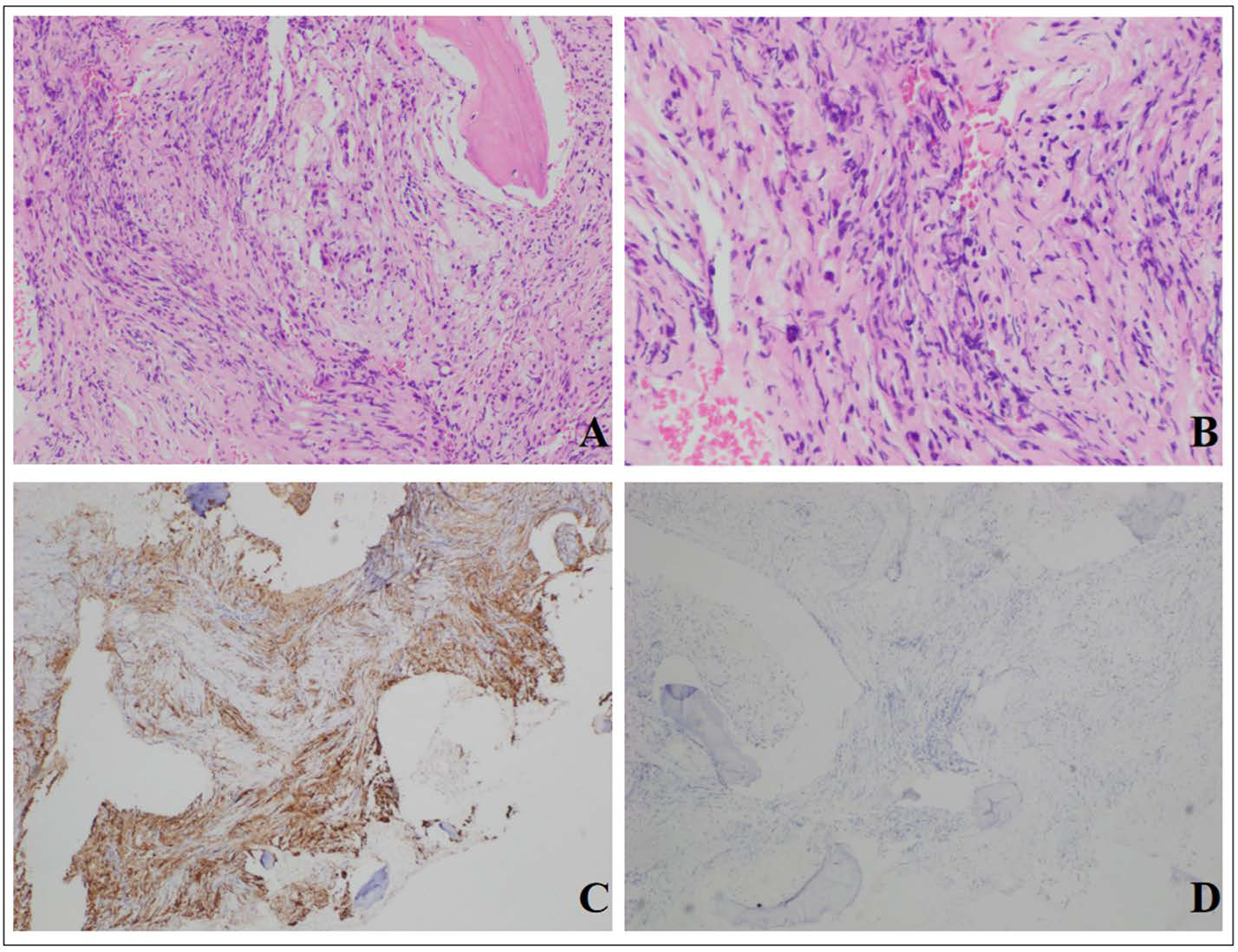 Then biopsy was then taken from right femur. Histological examination revealed fibrous tissue hyperplasia and foamy histiocytes distributed in nests between bone trabeculae (A, HE × 40; B, HE × 200). Immunohistochemistry (C-D) demonstrated CD68 (+), CD1a (?). P-CK (?), MP0 (scattered and focal +), CD21 (?), CD23 (?), Langerin (?), Ki-67 (+, approximately 3%).