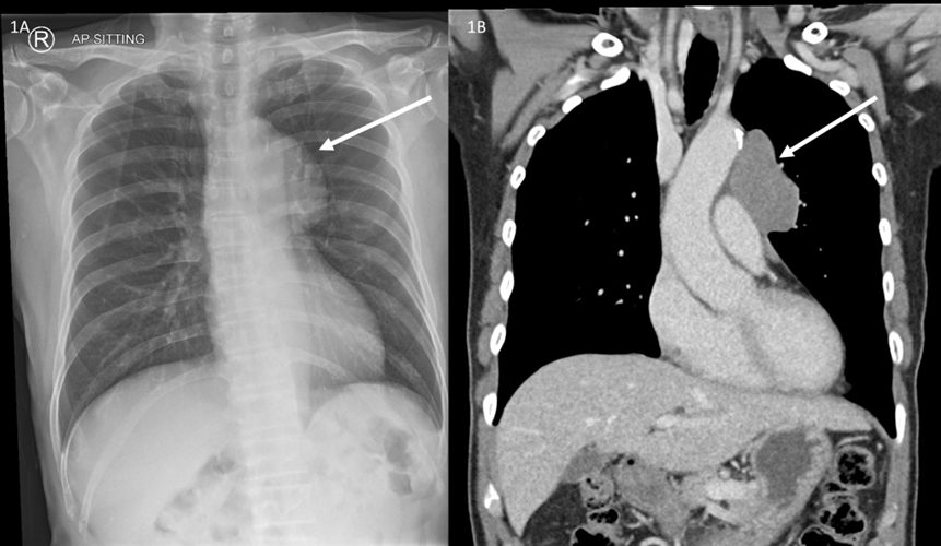 AP Chest radiograph demonstrating a mass overlapping the left hilum suggestive of an anterior mediastinal mass (white arrow).