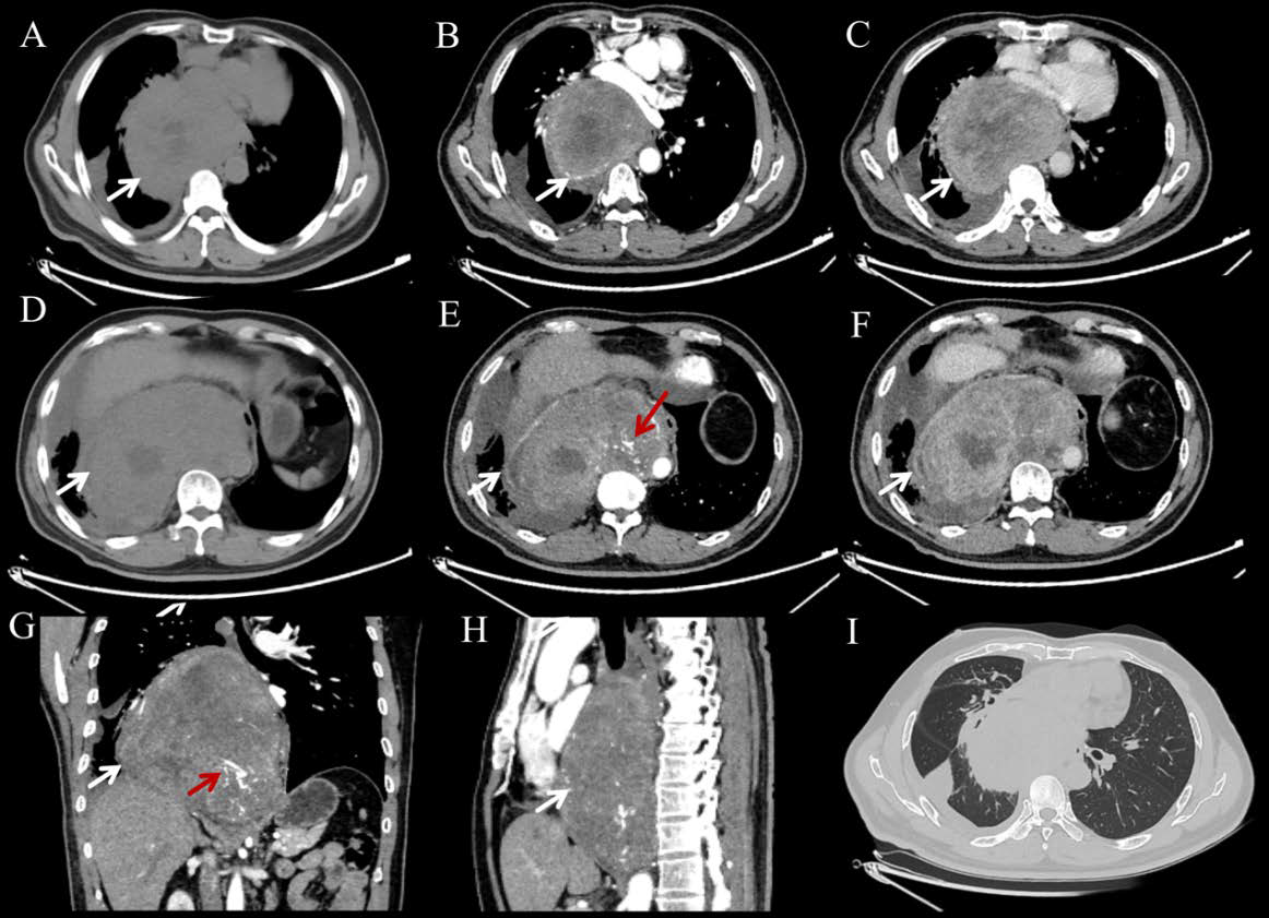 A: Non-contrast chest CT demonstrates a soft tissue mass located in the posterior mediastinum (white arrow indicates); B-C (Enhanced arterial and venous phases): The contrast-enhanced CT reveals a posterior mediastinal mass compressing the adjacent left atrium and pulmonary venous trunk (white arrow indicates); D: Non-contrast chest CT demonstrates a soft tissue mass located in the posterior mediastinum (white arrow indicates); E–H (Figures E, G and H show the arterial phase, while Figure F shows the venous phase): Contrast-enhanced chest CT (axial, coronal, and sagittal views) reveals a heterogeneously enhancing soft tissue mass in the posterior mediastinum (white arrow indicates), adjacent structures are compressed, and necrotic areas are observed within the lesion. Multiple small intralesional vascular structures are observed (red arrow indicates). The esophagus appears compressed and narrowed, and the interface between the lesion and the descending aorta is indistinct. I: Narrowing of a segmental bronchus in the right lung, accompanied by compression-induced consolidation and partial atelectasis.