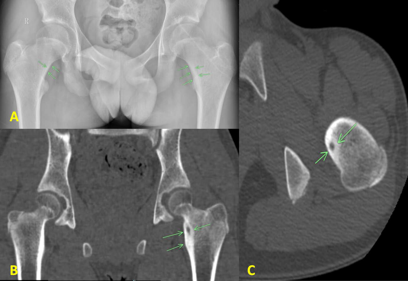 13-year-old male with intra-articular osteoid osteoma of the proximal left femur.