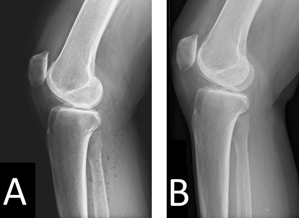Lateral radiographic view of the right knee showed multiple soft tissue gas projected over the posterior aspect of the proximal tibiafibula. (B) Follow-up radiograph performed 9 months later showed complete resolution of soft tissue gas.