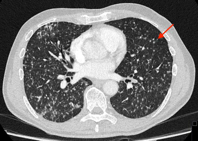 71-year-old male with disseminated tuberculosis following BCG therapy. FINDINGS: Axial chest CT shows numerous <2 mm randomly distributed nodules (arrow) involving both lungs concordant with miliary tuberculosis. TECHNIQUE: Axial contrast-enhanced chest CT using 120 kV, 180 mAs, 1.0 mm slice thickness, 100 mL iodinated contrast medium during venous phase.