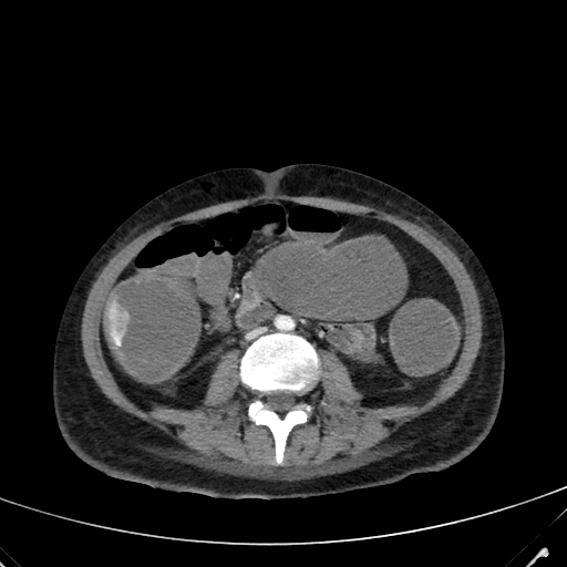 Axial contrast-enhanced CT scan of the abdomen showing active extravasation of intravenous contrast in the ascending colon, indicating active lower gastrointestinal bleeding.