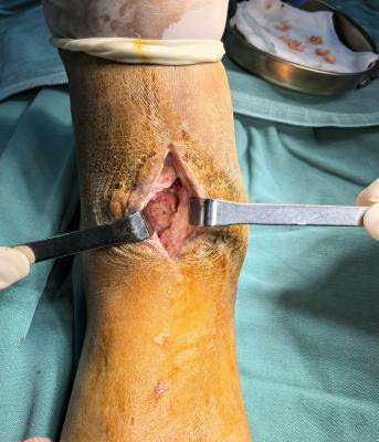 Photographs demonstrate cutaneous hyperpigmentation and crusted sinus tracts (1a), beaded granulomatous nodules of subcutaneous tissue during operation (1b, black arrow), and partial nodular lesions after surgical resection (1c).